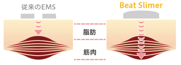 ダイエットも脱毛もセルフの時代？短期間で痩せられると話題の電磁